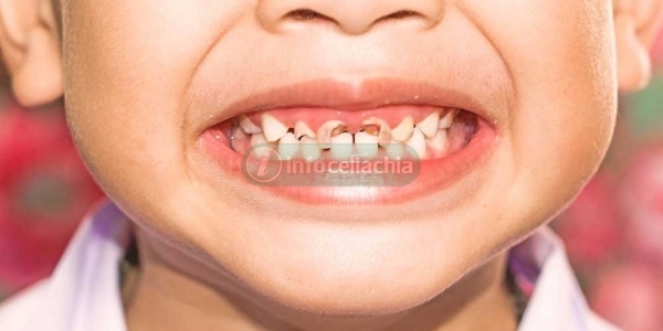 Più problemi ai denti nei bimbi affetti da celiachia